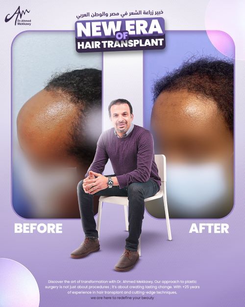 تجارب زراعة الشعر في مصر مع دكتور أحمد مكاوي